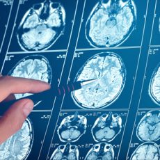 Neurodegenerative Diseases