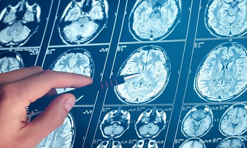 Neurodegenerative Diseases